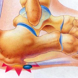 PlantarFasciitis