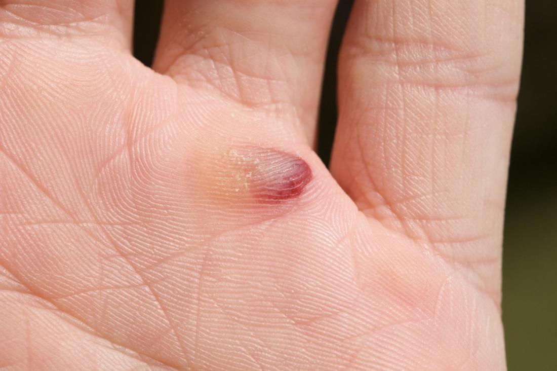 blood-blister-on-persons-palm